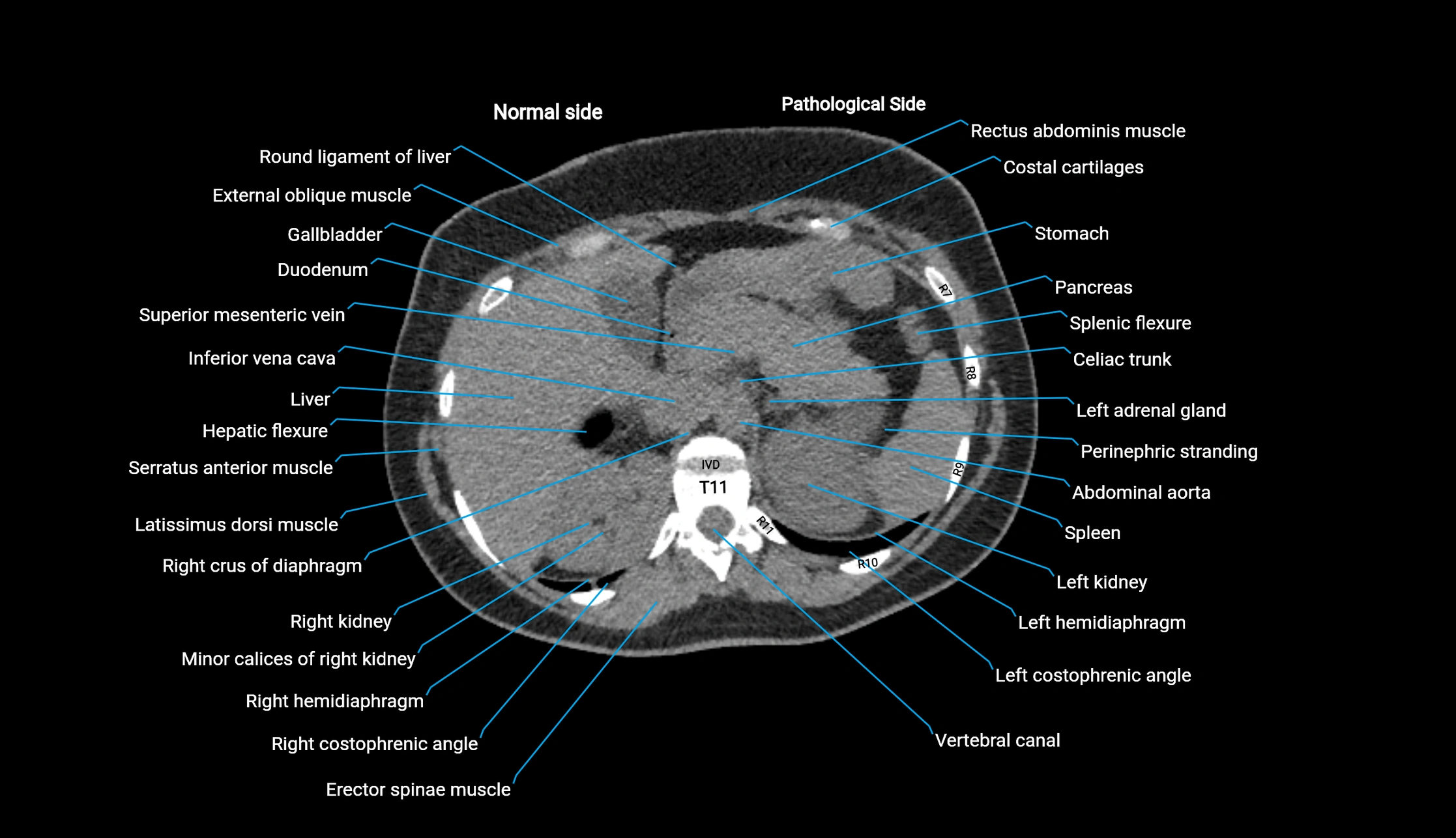 CT KUB axial cross sectional anatomy  radiology image -img-00201-00022.webp